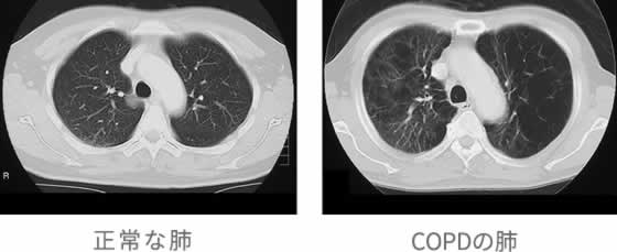 正常な肺とCOPDの肺のレントゲン