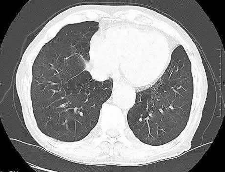 COPDの胸部CT