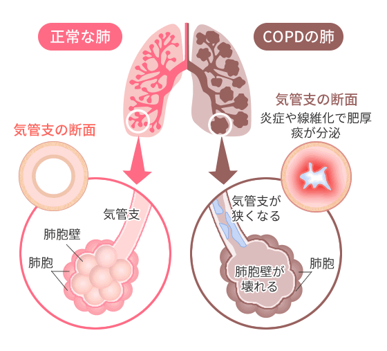 COPDの肺イラスト