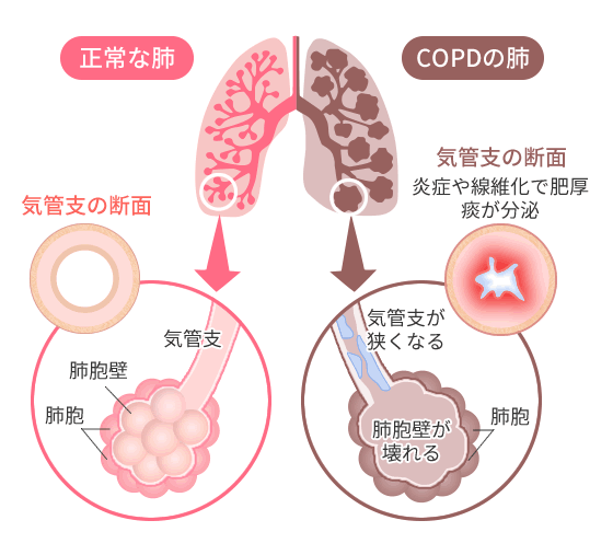 Copd 慢性閉塞性肺疾患 または肺気腫 慢性気管支炎 箕面市 豊中市 池田市 茨木市での在宅医療 訪問診療 往診 もみじ在宅診療所